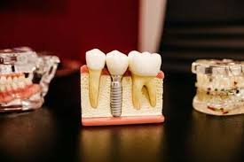 Affordable dentures